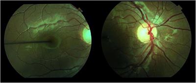 Vascular Complication in Adolescents With Diabetes Mellitus